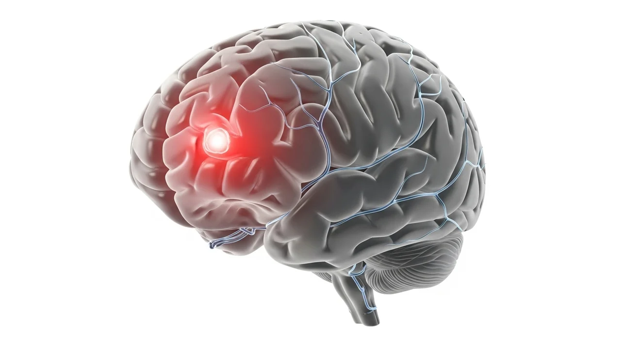 풍증상이란 무엇인가? 뇌가 보내는 마지막 경고