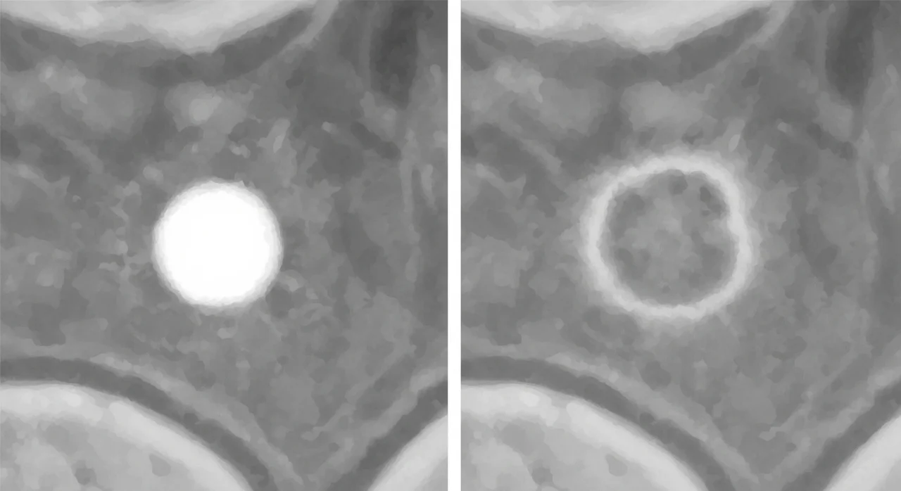 폐석회화와 폐암, 어떻게 구분하나요?